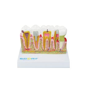 Modelo de Patologias Dentárias SD-5202
